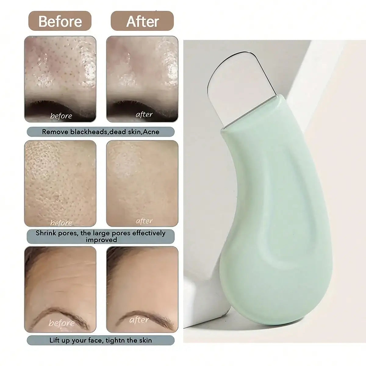 Stainless Steel Blackhead & Pimple Extractor Tool Blackhead Extractor Tool QXL