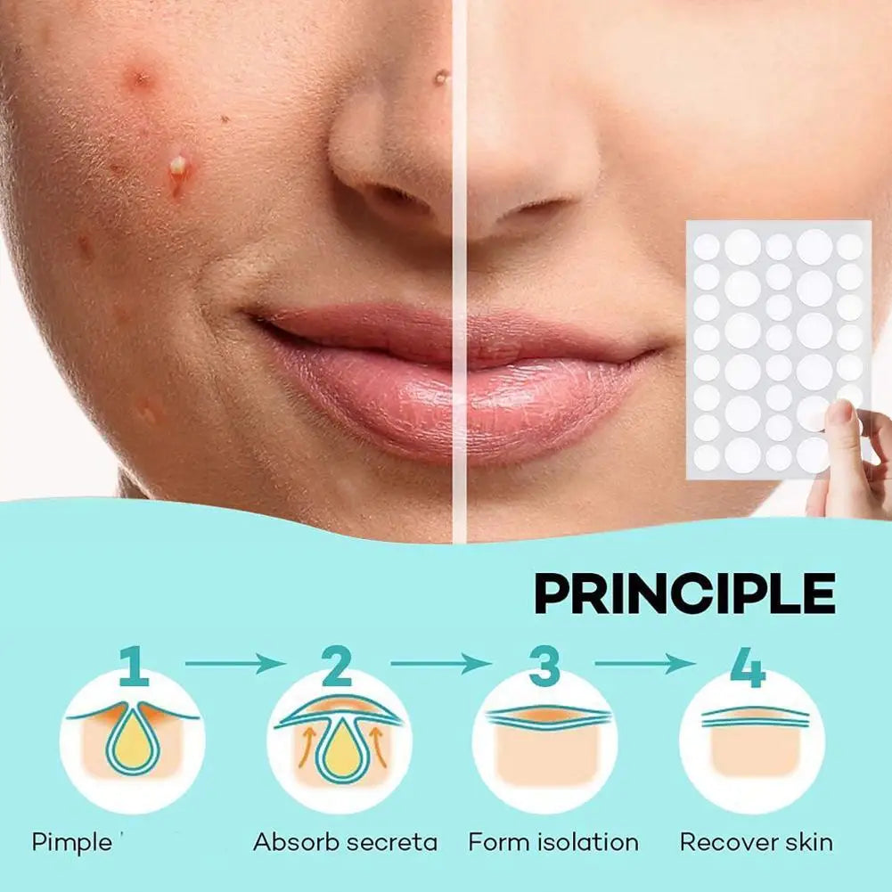 Hydrocolloid Pimple Patches with Tea Tree Oil | 72 or 288 Pack Acne Pimple Patches QXL