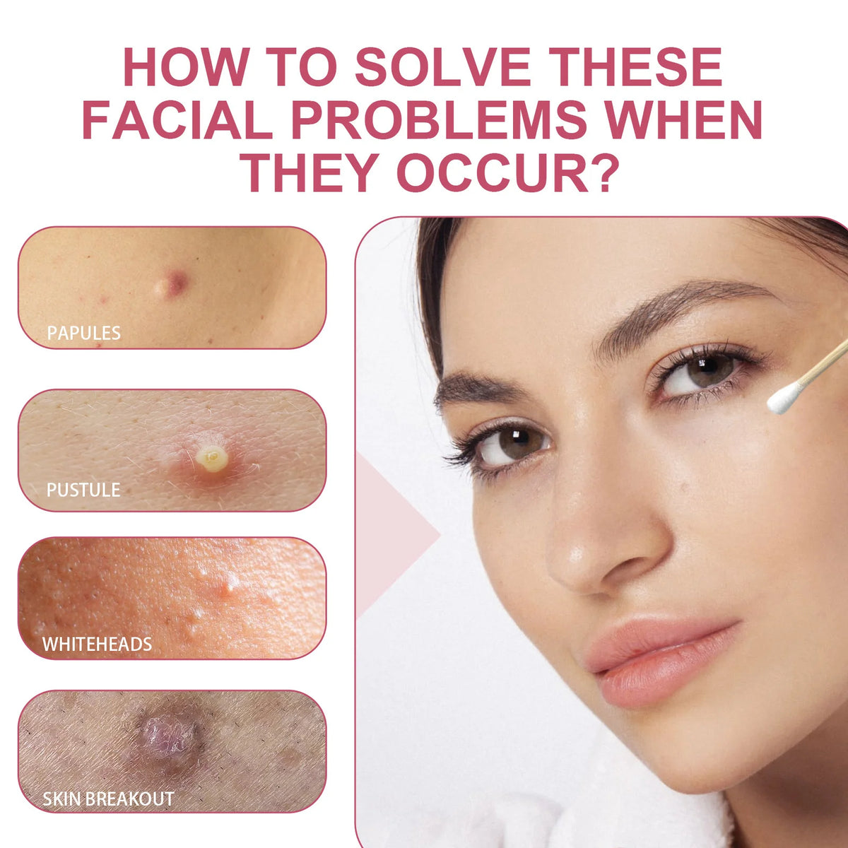 Salicylic Acid Pore-Clearing Acne Solution 30ml | Oil Control Acne Spot Treatment QXL