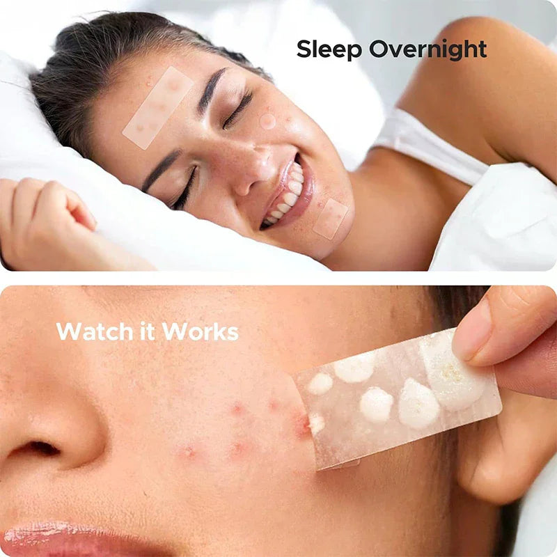 Hydrocolloid Acne Patches – Face, Nose, Chin & Body Hydrocolloid Acne Patch QXL