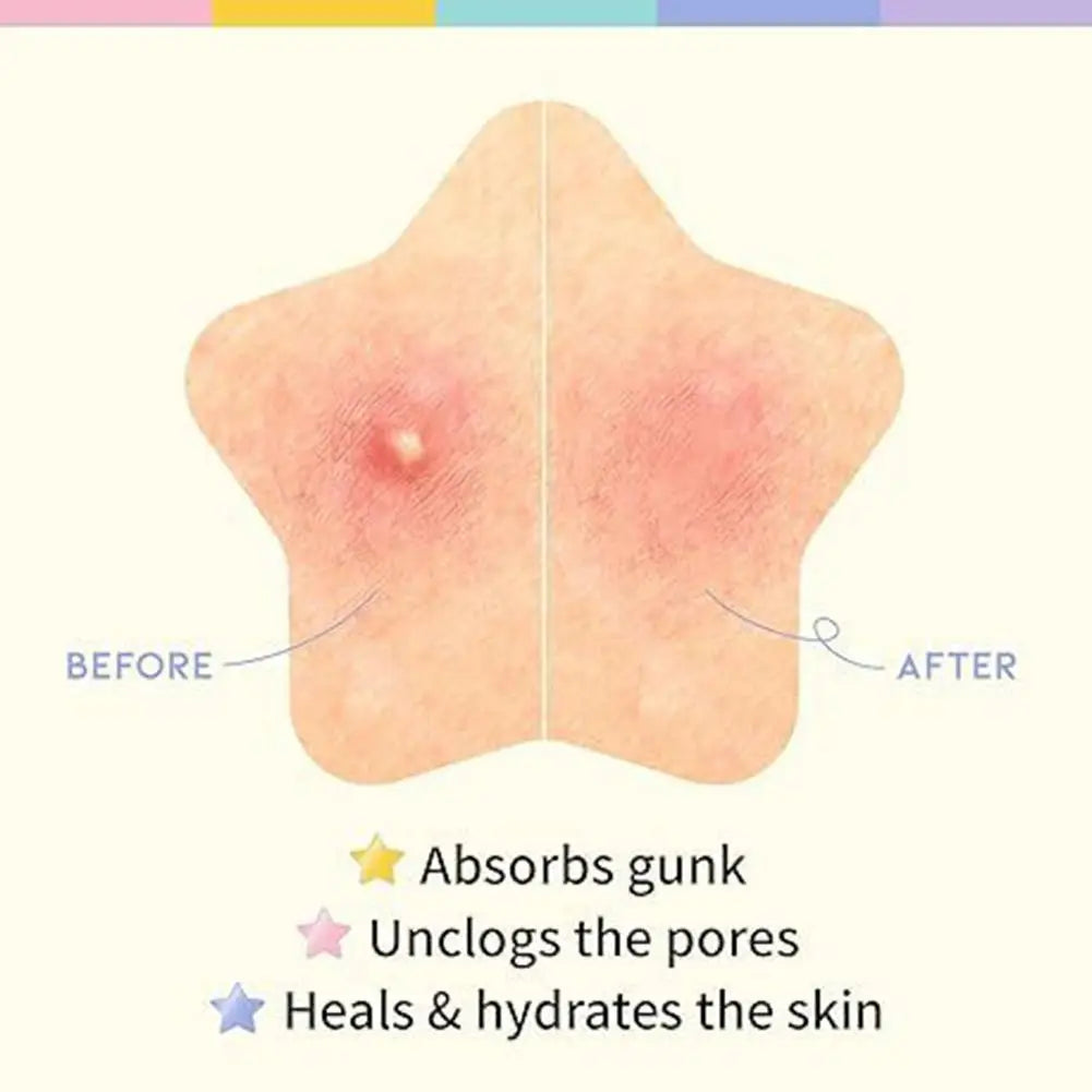 200/240-Pack Hydrocolloid Pimple Patches | Invisible Spot Covers Pimple Patches QXL