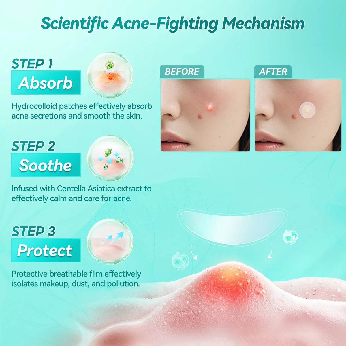 LANBENA Acne Pimple Patch – Invisible Blemish Stickers Acne Pimple Patch QXL