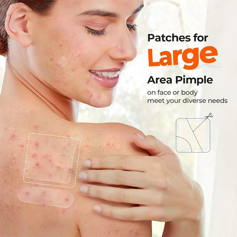 Hydrocolloid Acne Patches – Face, Nose, Chin & Body Hydrocolloid Acne Patch QXL