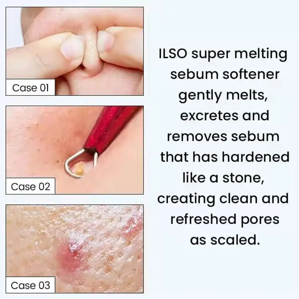 Blackhead Dissolving T-Zone Serum | Pore Cleansing Essence 150ml Pore Cleansing Serum QXL