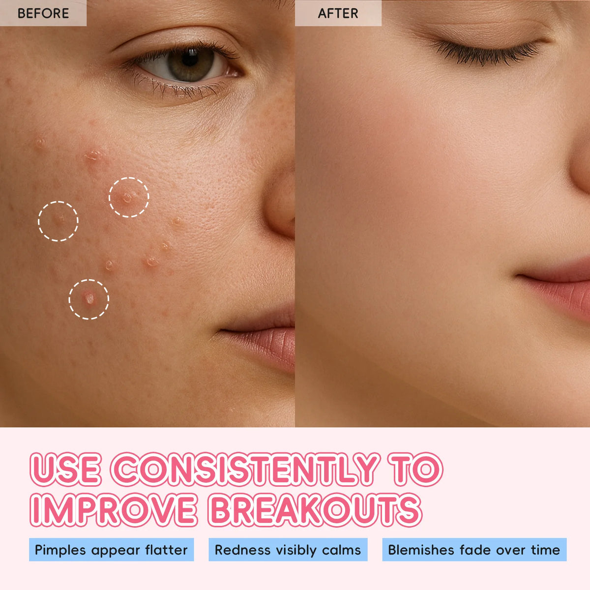 LAIKOU Sakura Hydrocolloid Pimple Patches – 24 Cute Shapes Pimple Patches QXL