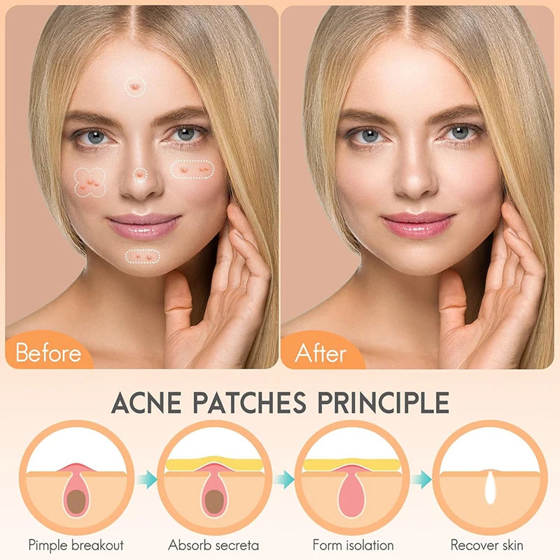 128-Pc Invisible Pimple Patches | Colorful Acne Cover Stickers Acne Pimple Patches QXL
