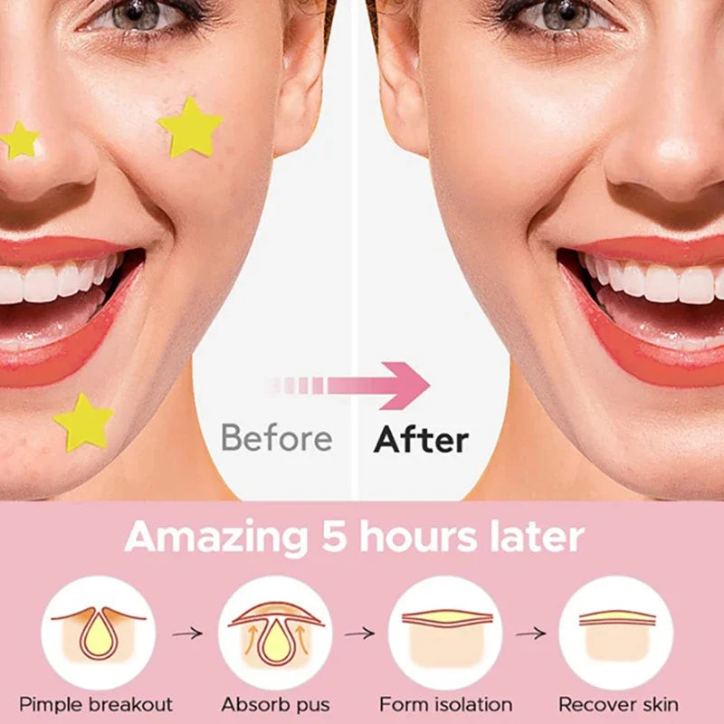360-Pack Heart Star Acne Patches | Invisible Blemish Dots Acne Pimple Patches QXL