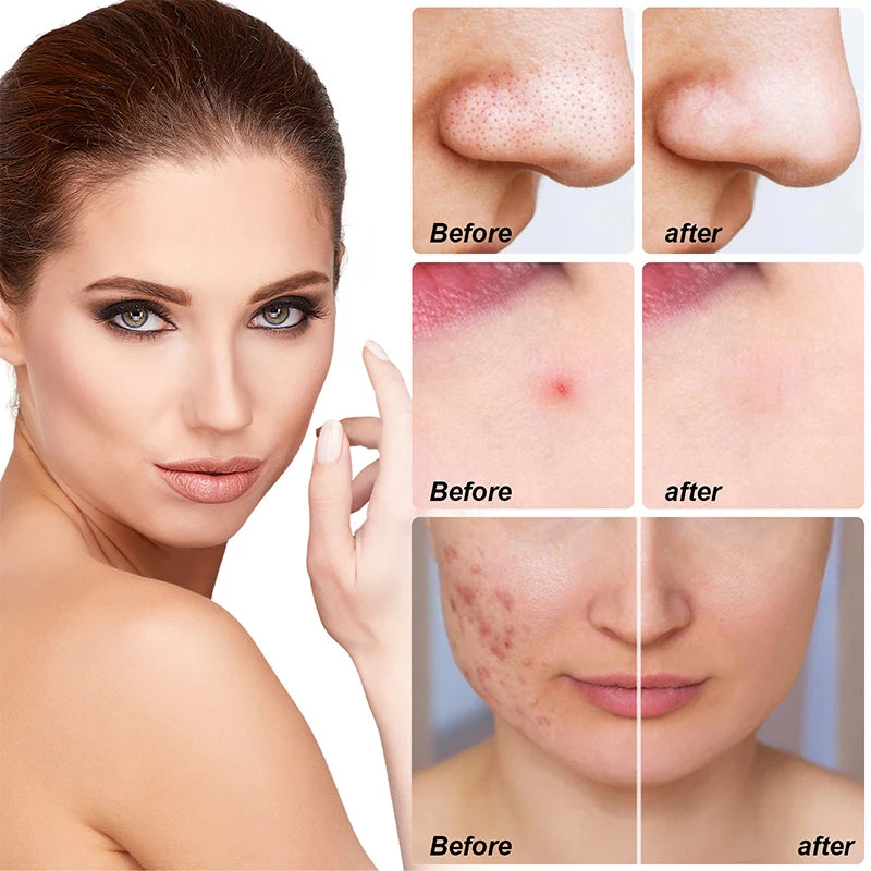 Large Full-Face Hydrocolloid Pimple Patches – 5 Pack Hydrocolloid Pimple Patch QXL