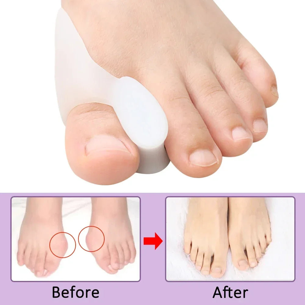 Gel Toe Separator & Bunion Corrector Spacer | 2/4/8-Pack Gel Toe Separator QXL