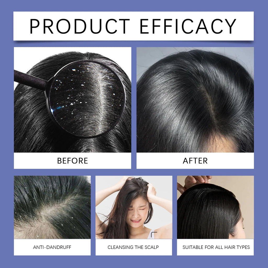 HOEGOA Selenium Sulfide Shampoo 120ml – Dandruff Control Anti-Dandruff Shampoo QXL