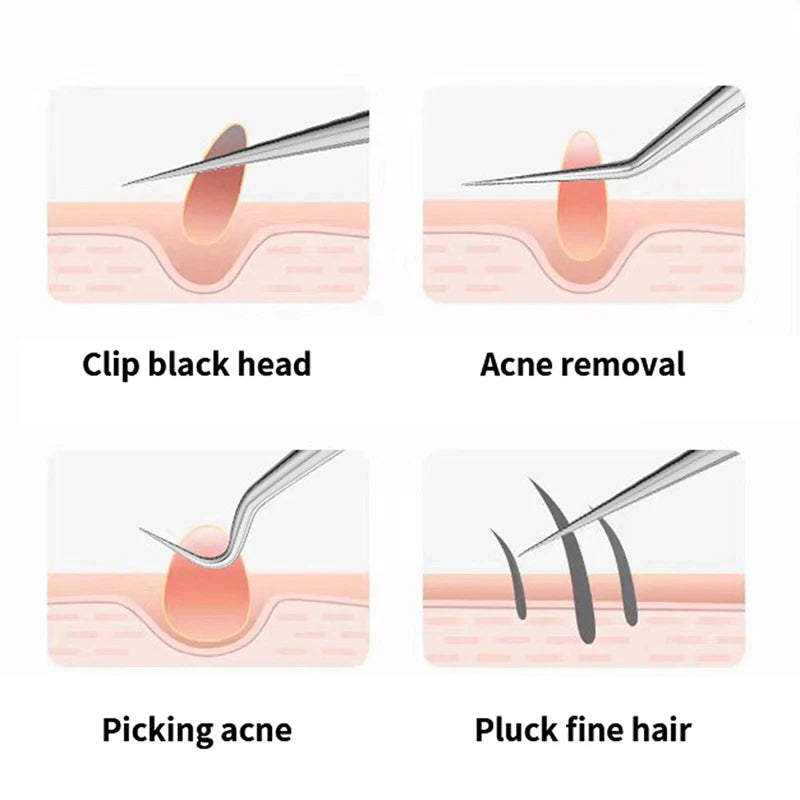 Blackhead Extractor Tweezers with LED Light | 3 Tip Styles Blackhead Extractor Tool QXL