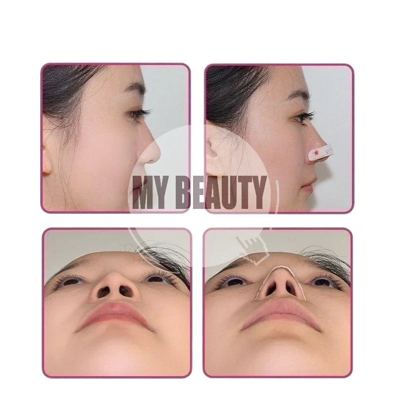 Adjustable Nose Lift Shaping Strips | Breathable Alar Slimming Nose Shaping Strip QXL